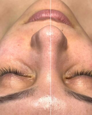 DEEP PORE FACIAL WITH DERMAPLANE
⠀
If you're in need of a deep clean look no further!
Included in this package is a deep cleanse with facial steam, extraction session, dermaplane and a chemical peel to cleanse the deepest layers of the skin. Followed by full face algae peel off mask and lymphatic drainage with icy cryo globes.
⠀
Not sure what kind of treatment you want or need?
📲Give me a call or text and I am happy to help you choose the perfect treatment 617.538.1763
 🔗or Learn more through the link in bio.
⠀
#deepporefacial #chemicalpeel #dermaplanefacial #dermaplanefacial 
#lashlift #lashliftboston #lashtint
#fireandicefacial #astrodomefacial #oxygenfacial #ledtherapy #olenasblog #olenasbeautyblog #beautybloggers  #bostonbusinesswoman #wellesleymedspa #lifetimemetrowest #bostonblogger #lashtintingboston #bostonfacial #bostonglobe #equinox #equinoxchestnuthill #bostonyoga #spaboston #metrowestfacial #bostonmagazine #dermaplaningboston #botoxboston #oestheticswayland